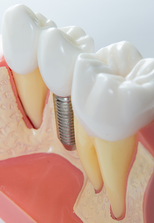 Model of a dental implant in Madison between two natural teeth