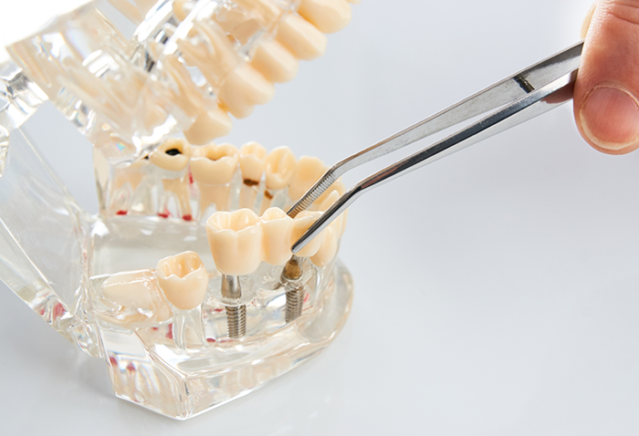 Hand placing a dental bridge over two dental implants in a model of the mouth