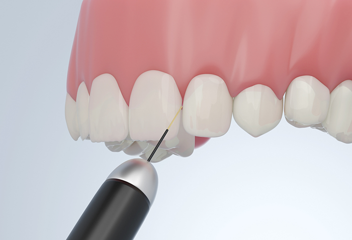 Illustration of a dental laser treating the gums