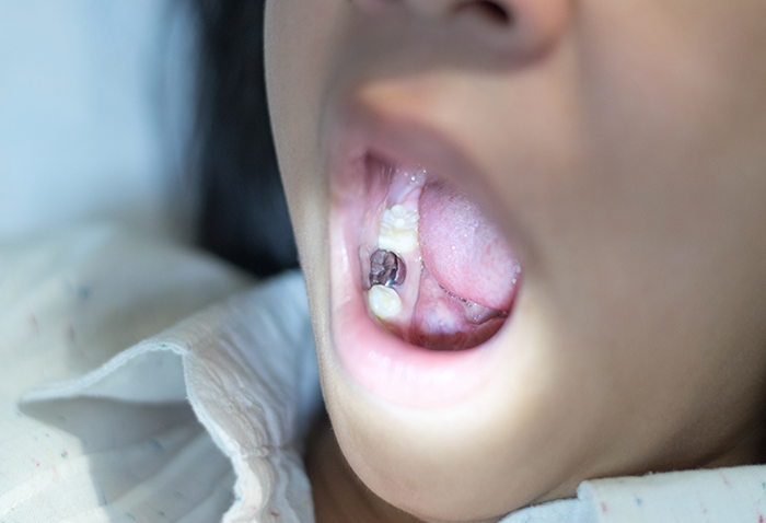 Child with a metal dental crown covering one tooth