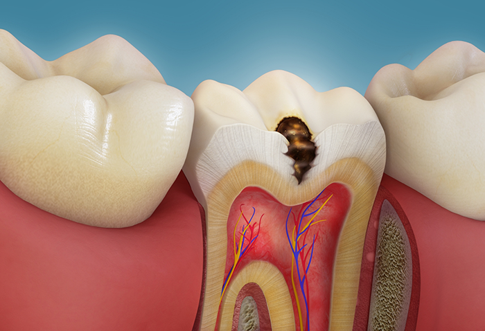 Illustration of a severely decayed tooth