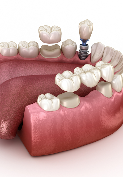 Illustration of a dental bridge and a dental implant replacing missing teeth in Madison
