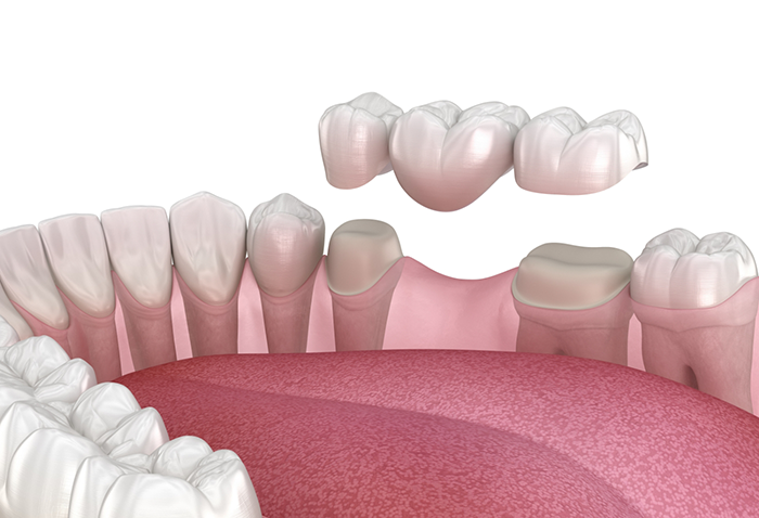 Illustration of a dental bridge being fitted over two teeth to fill the gap between them