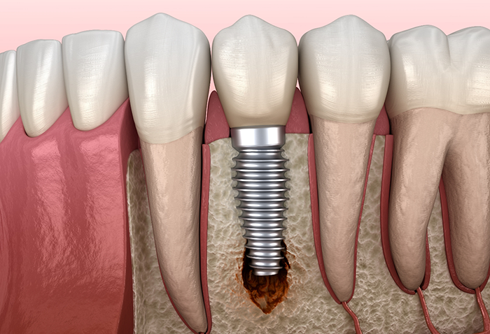 Illustration of a dental implant in the lower jawbone
