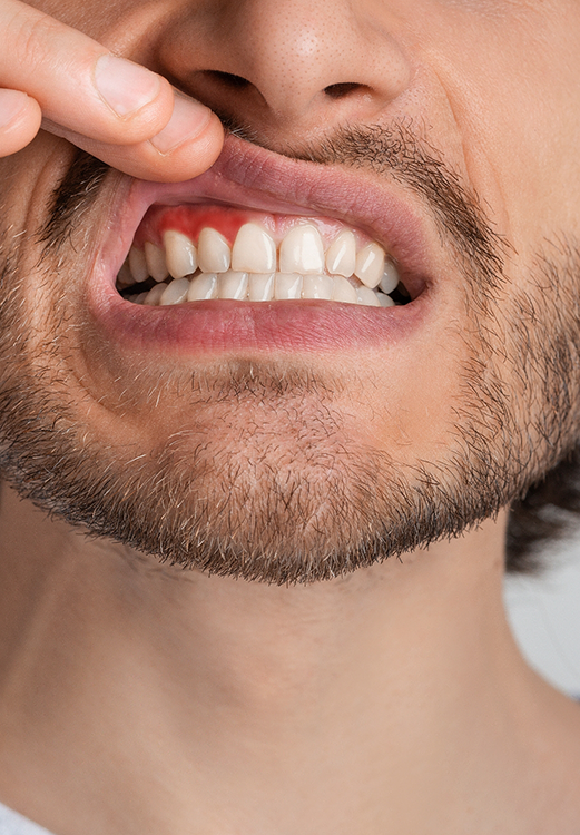 Man pointing to a red spot in his gums before gum disease treatment in Madison