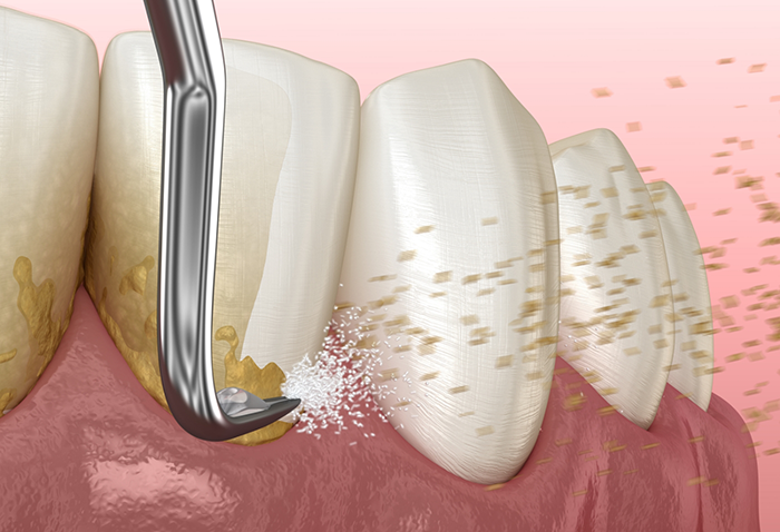Illustration of a dental scaler clearing tartar buildup from the teeth and gums