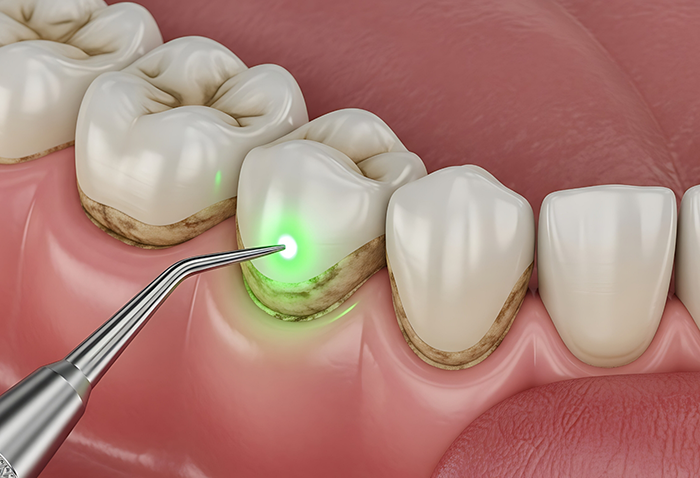 Illustration of a dental laser treating the teeth