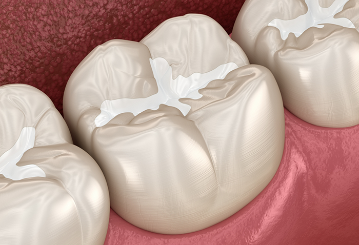Illustration of teeth with white fillings