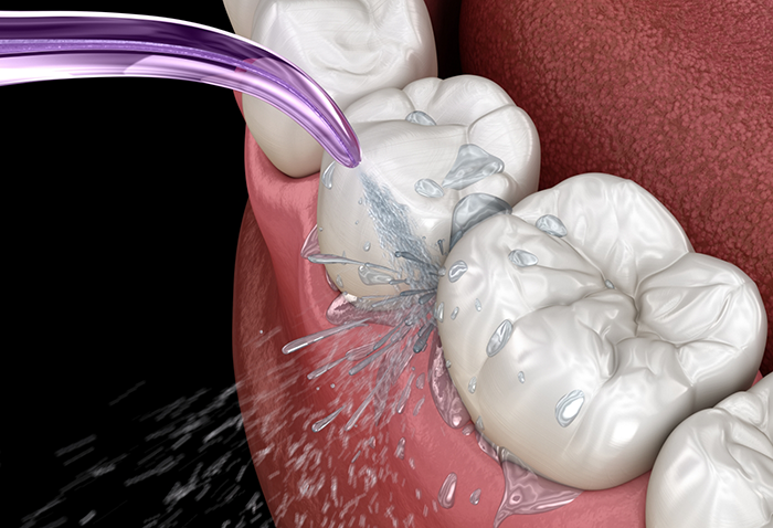 Illustration of teeth being sprayed with water during a dental cleaning