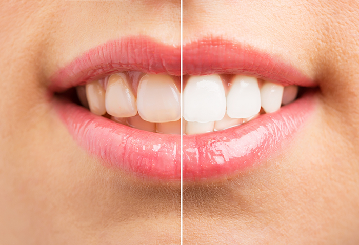 Close up of a smile before and after teeth whitening