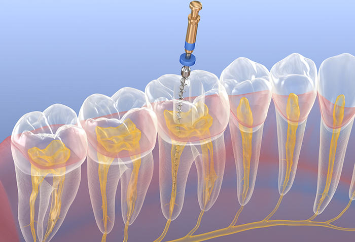 Illustration of a thin dental instrument treating the inside of a tooth