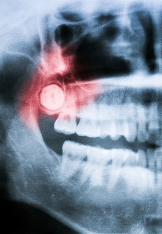 X ray of teeth with a wisdom tooth highlighted red